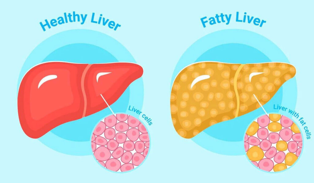 फैटी लीवर (Fatty Lever)
